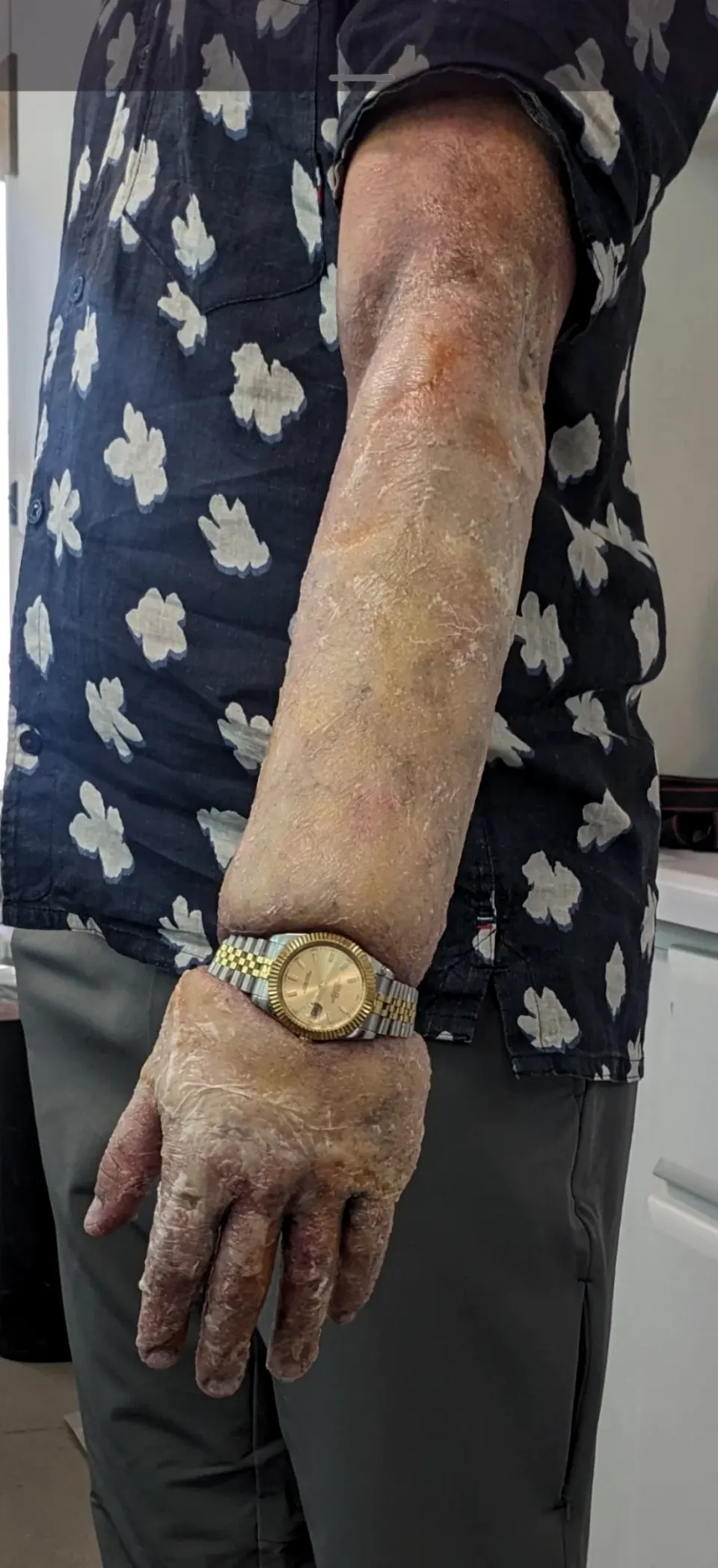 Bloated Arm, prosthetic makeup by Main Character Creations (photo 6)
