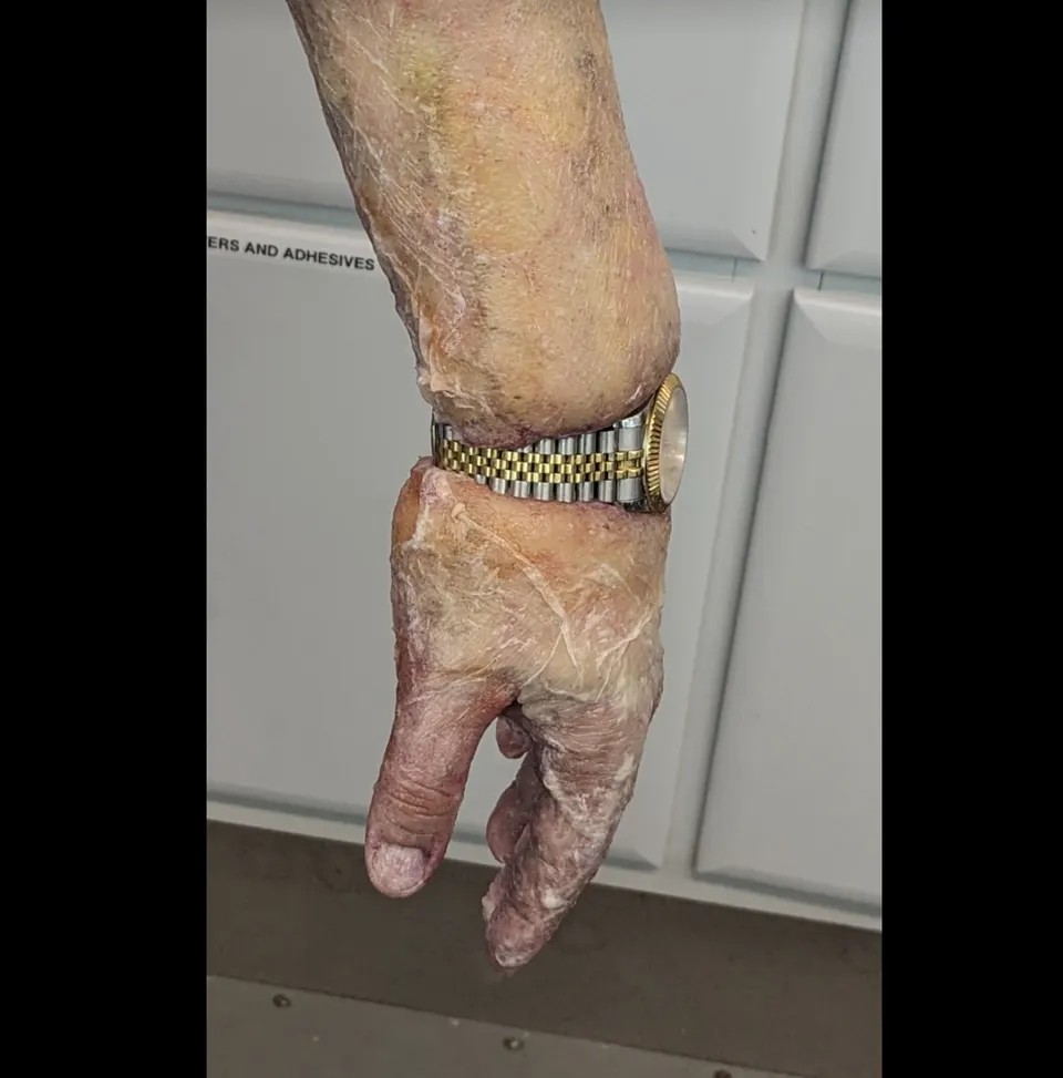 Bloated Arm, prosthetic makeup by Main Character Creations (photo 7)
