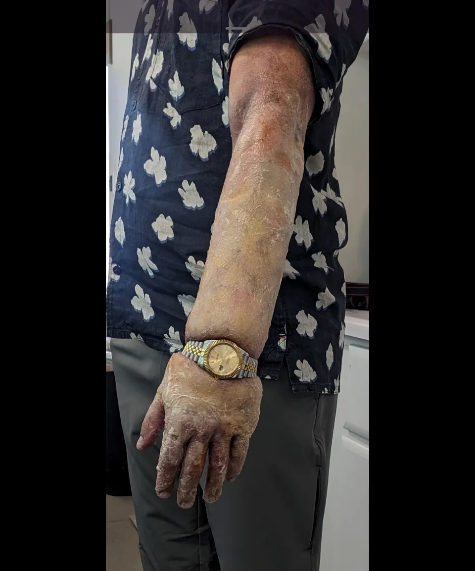Bloated Arm, prosthetic makeup by Main Character Creations (photo 9)