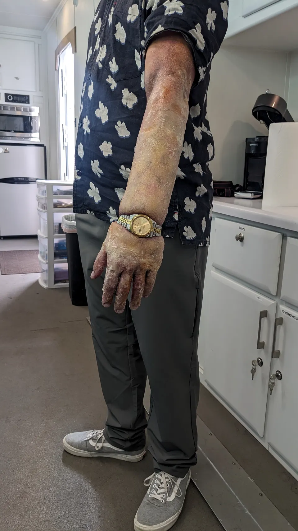 Bloated Arm, prosthetic makeup by Main Character Creations (photo 11)