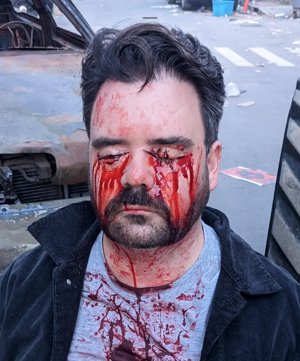 Lacerations & Wounds